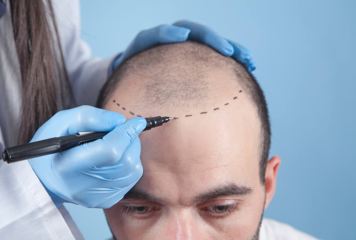 DHI Hair Transplant