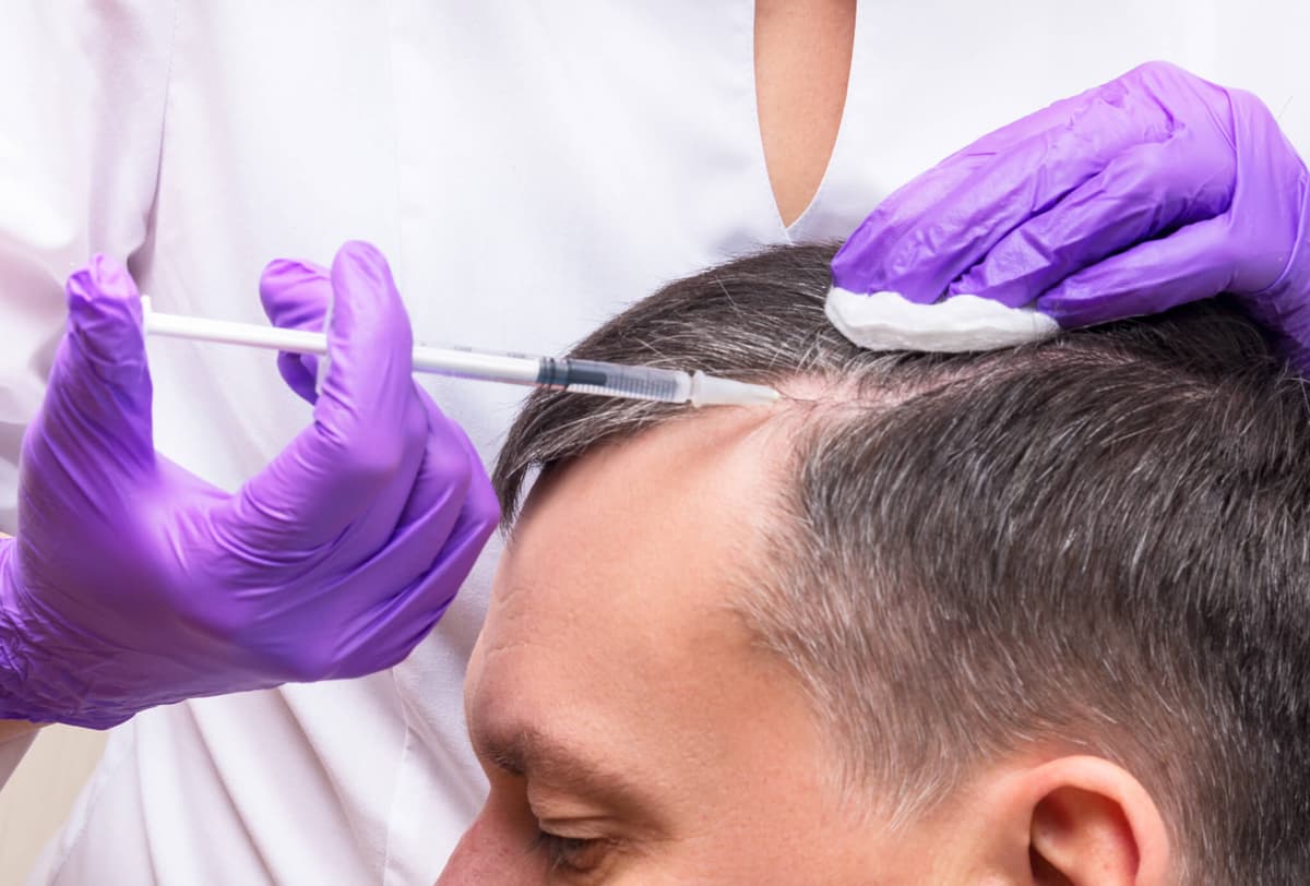 FUE Hair Transplant