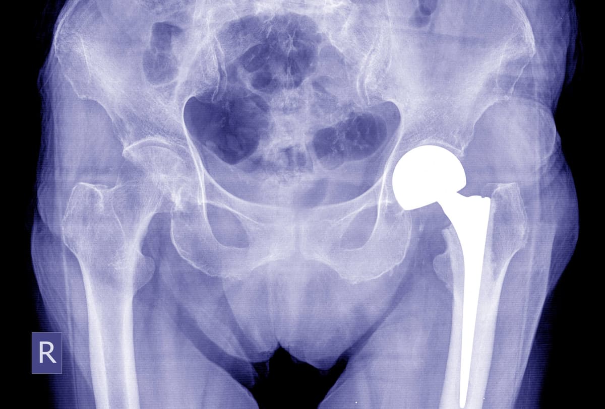 Hip Replacement